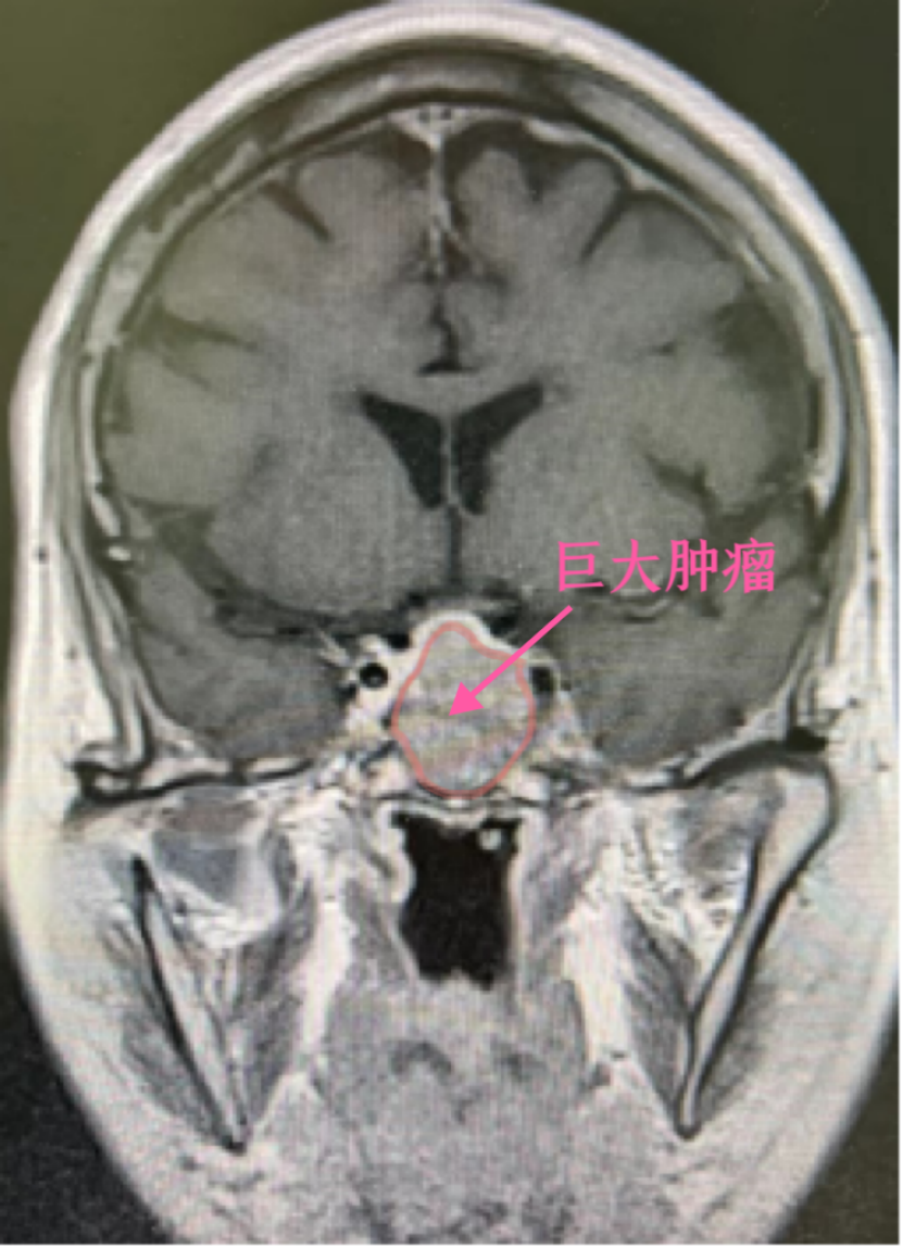 病例分享|伽玛刀，为高龄脑肿瘤患者带来生命的希望