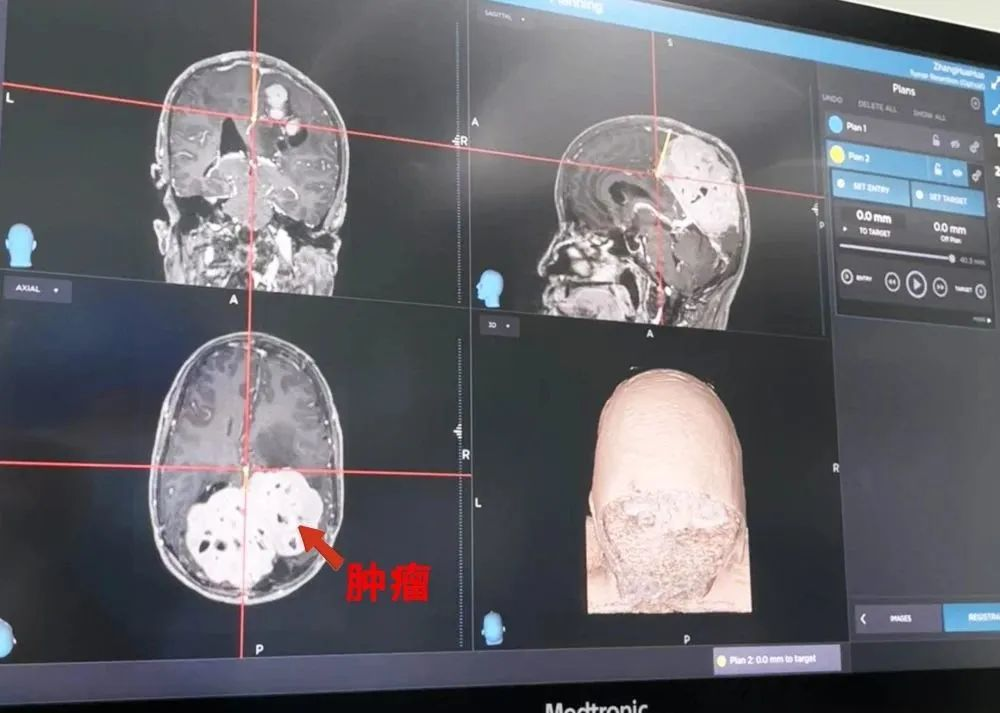 病例分享|金沙洲医院神经导航协助专家开展巨大脑膜瘤手术！